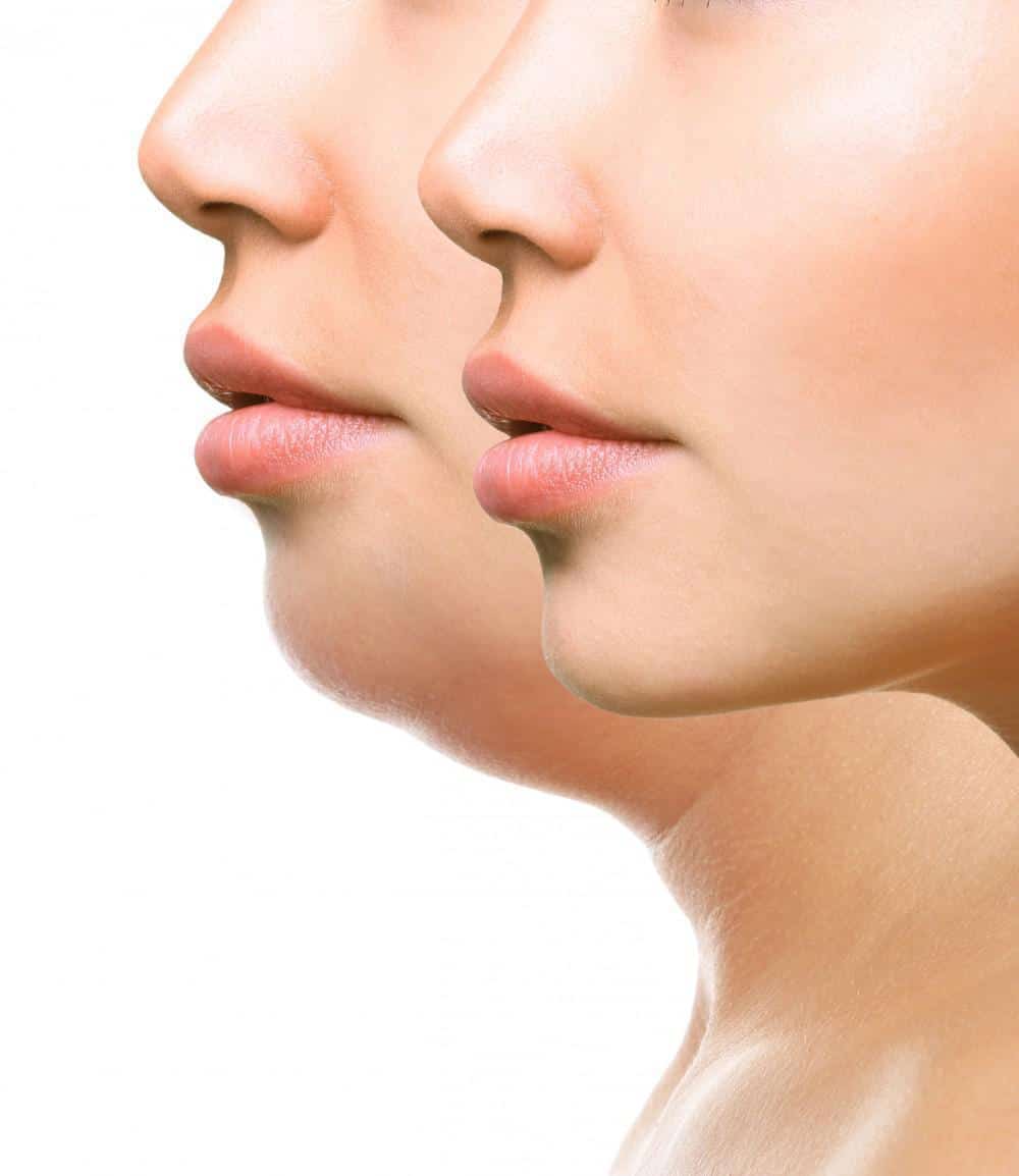 How to lose chin and neck fat fast sale