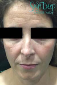 Before Image: Skin Rejuvenation