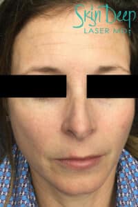 After Image: Skin Rejuvenation