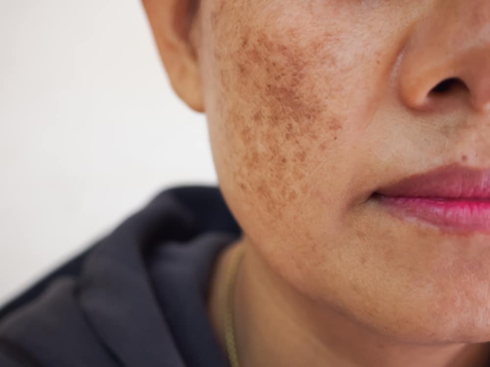 A close-up shot of melasma on a woman’s cheek